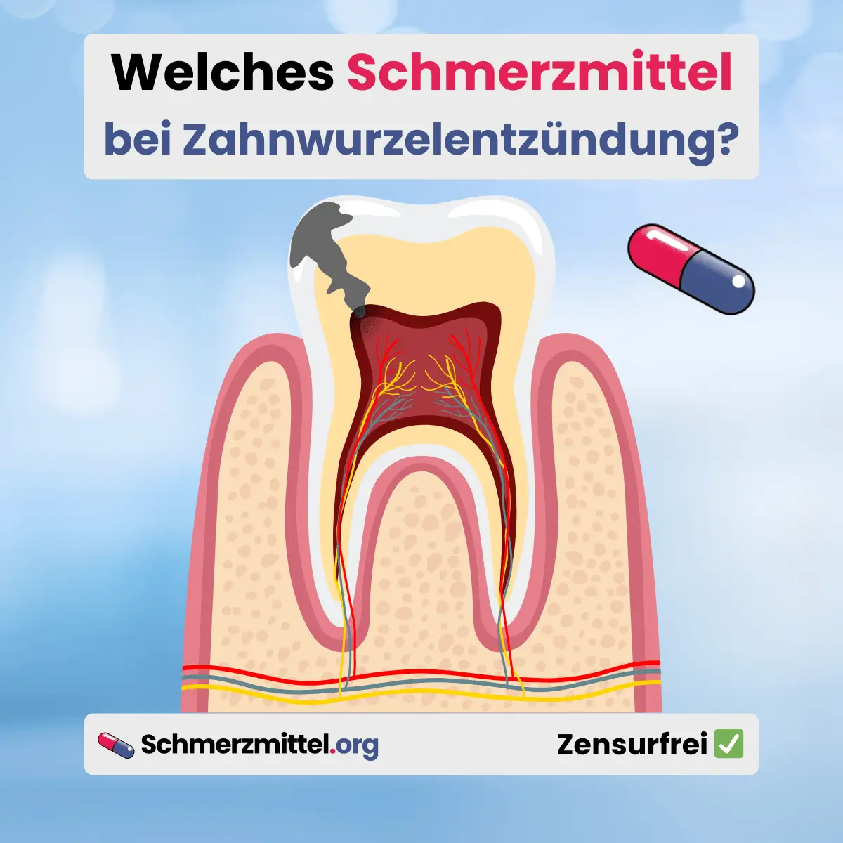 Welches Schmerzmittel bei Zahnwurzelentzündung