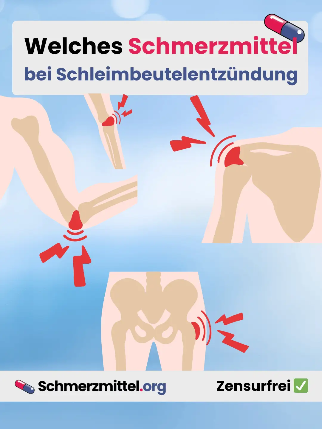 Bursitis Welches Schmerzmittel bei Schleimbeutelentzündung Teilen