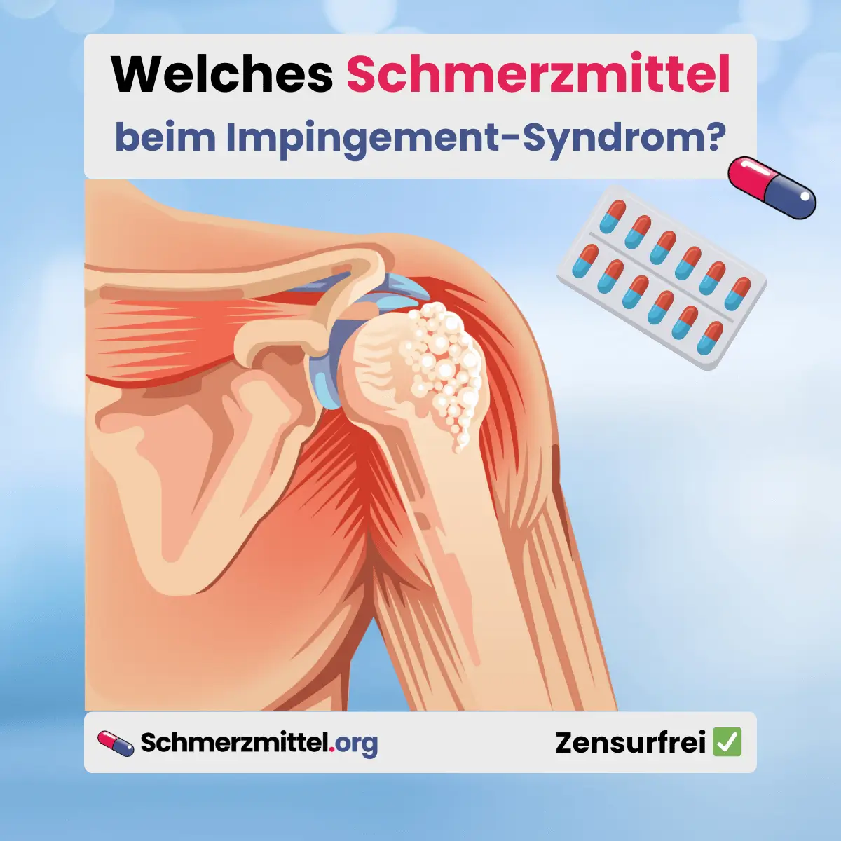 Schulterengpass Welches Schmerzmittel bei Impingement Schulter Schmerzen