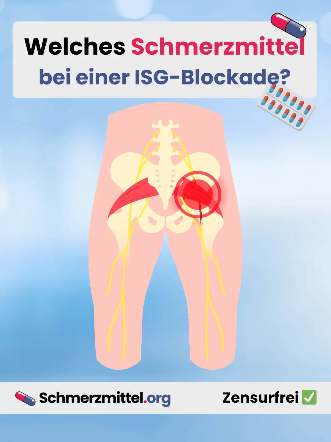Welches Schmerzmittel bei ISG-Blockade Teilen