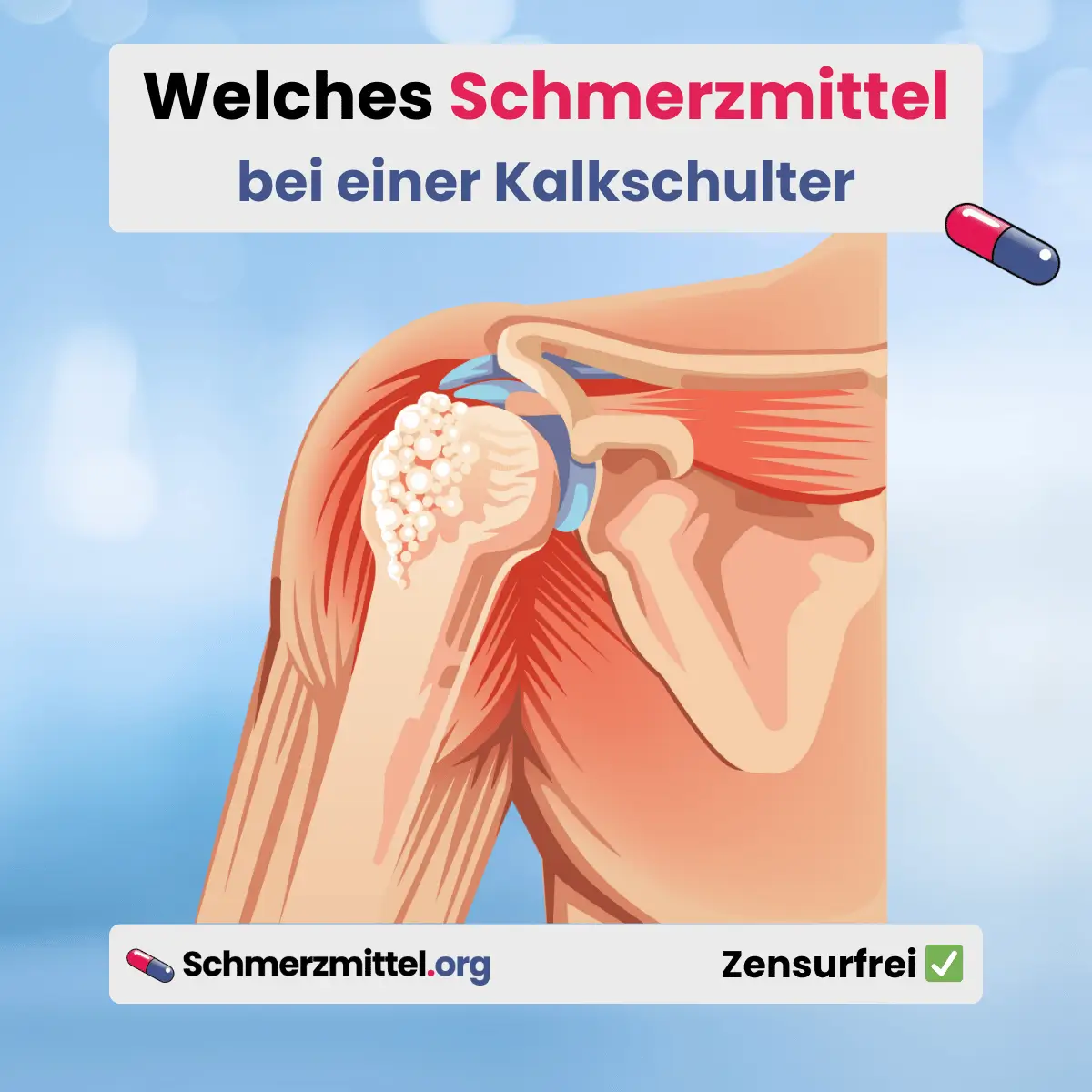 Welches Schmerzmittel bei Kalkschulter Tendinosis calcarea Kalk in der Schulter