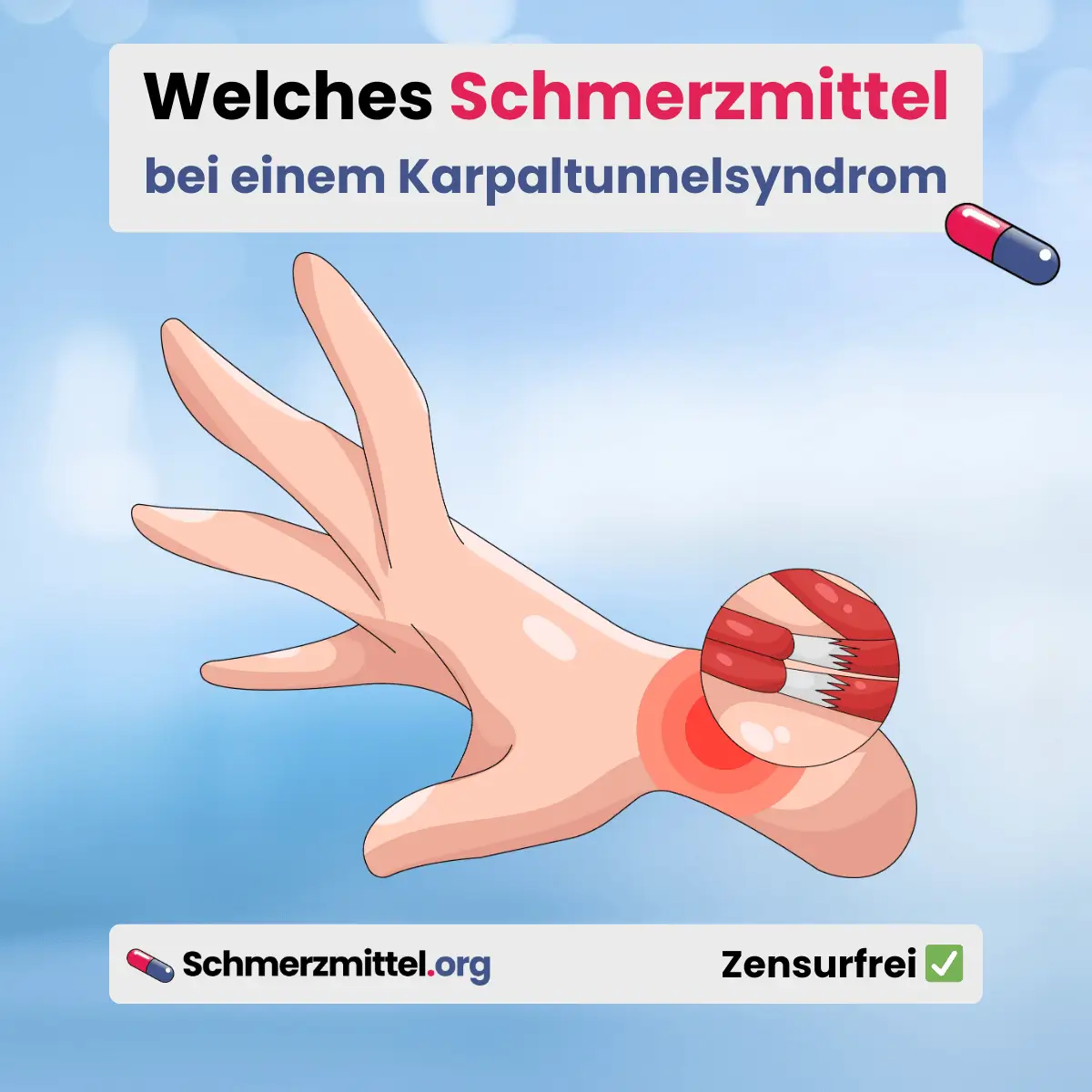 Welches Schmerzmittel bei Karpaltunnelsyndrom