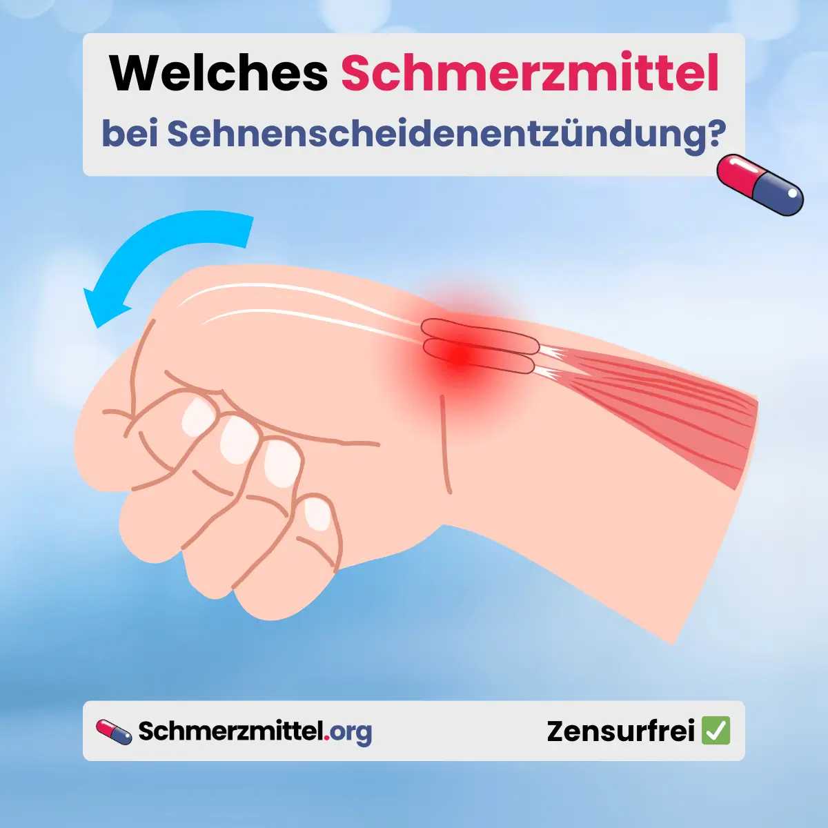 Welches Schmerzmittel bei Sehnenscheidenentzündung