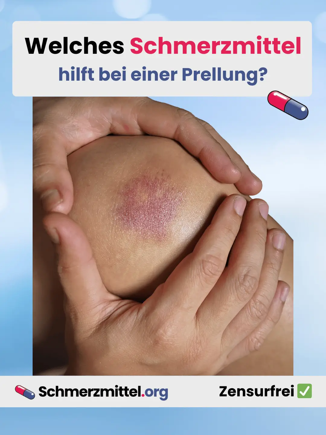 Welches Schmerzmittel bei prellung Teilen