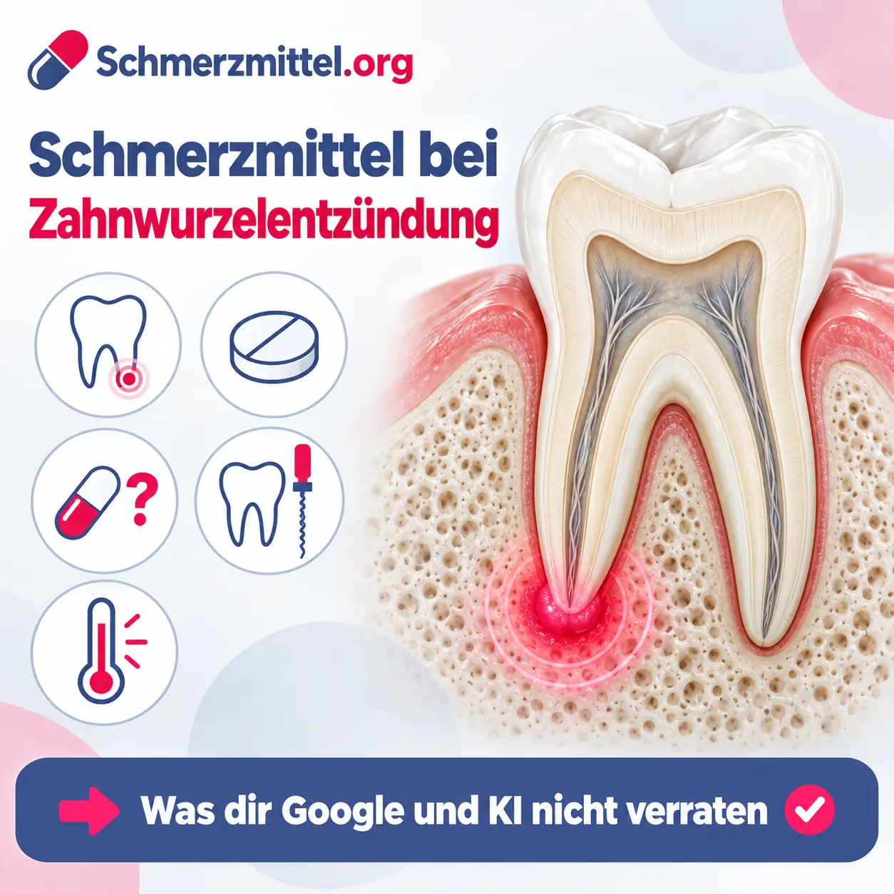 Zahnwurzelentzündung, 3D-Modell eines Backenzahns im Längsschnitt mit rot leuchtender Entzündung an der Wurzelspitze im Kieferknochen, daneben Medikamentenpackung, Icons zu Wurzelentzündung, Schmerzmittel, Antibiotikum, Wurzelbehandlung und Fieber